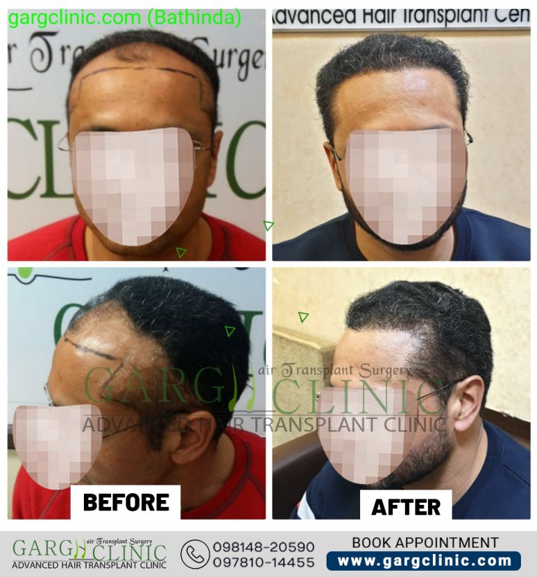 Garg Hair Transplant Clinic