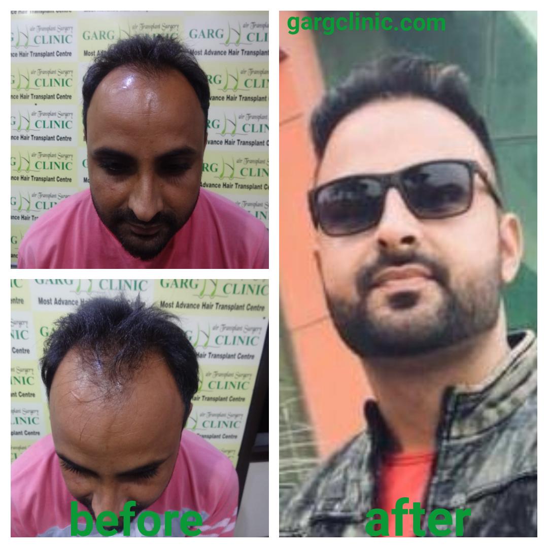 Garg Hair Transplant Clinic
