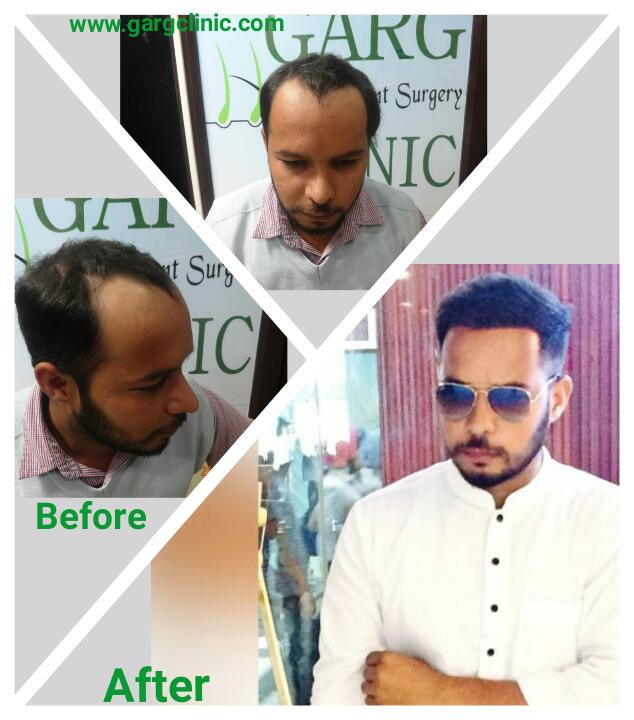 Garg Hair Transplant Clinic