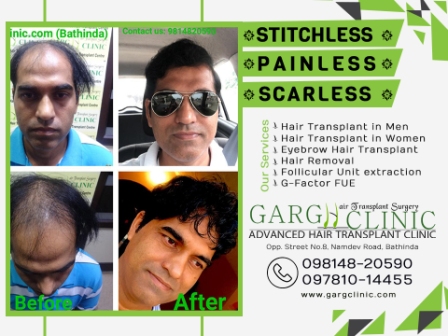 Garg Hair Transplant Clinic