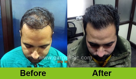 Garg Hair Transplant Clinic