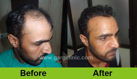 Garg Hair Transplant Clinic