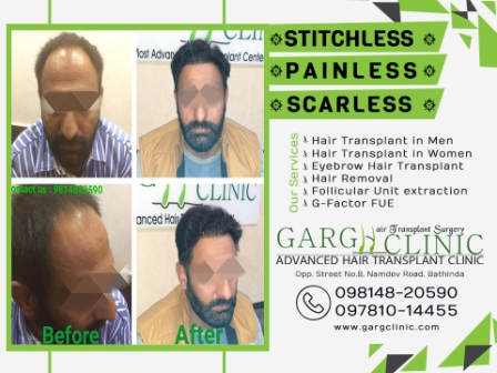 Garg Hair Transplant Clinic