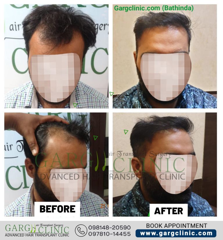 Garg Hair Transplant Clinic