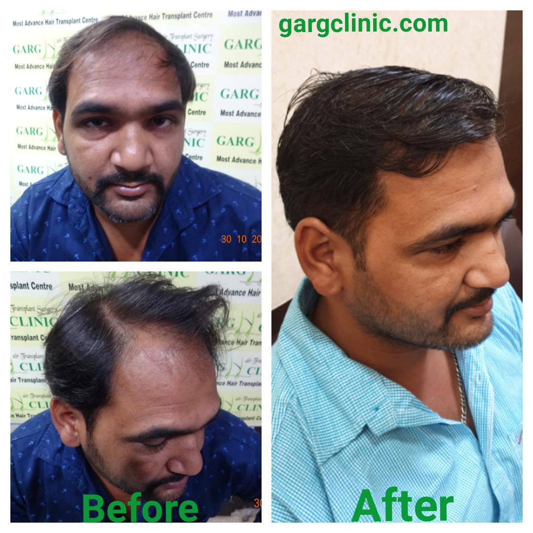 Garg Hair Transplant Clinic
