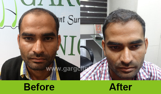 Garg Hair Transplant Clinic