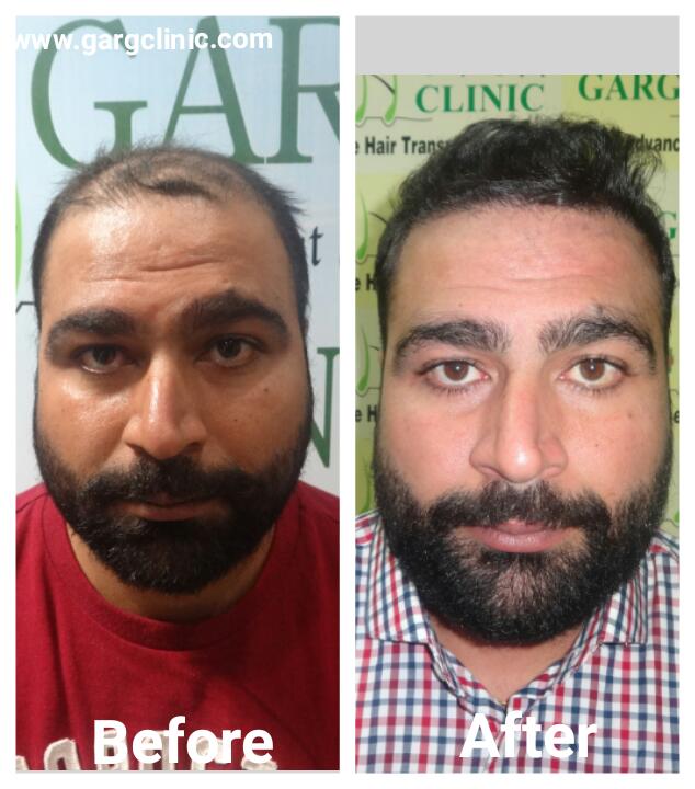 Garg Hair Transplant Clinic