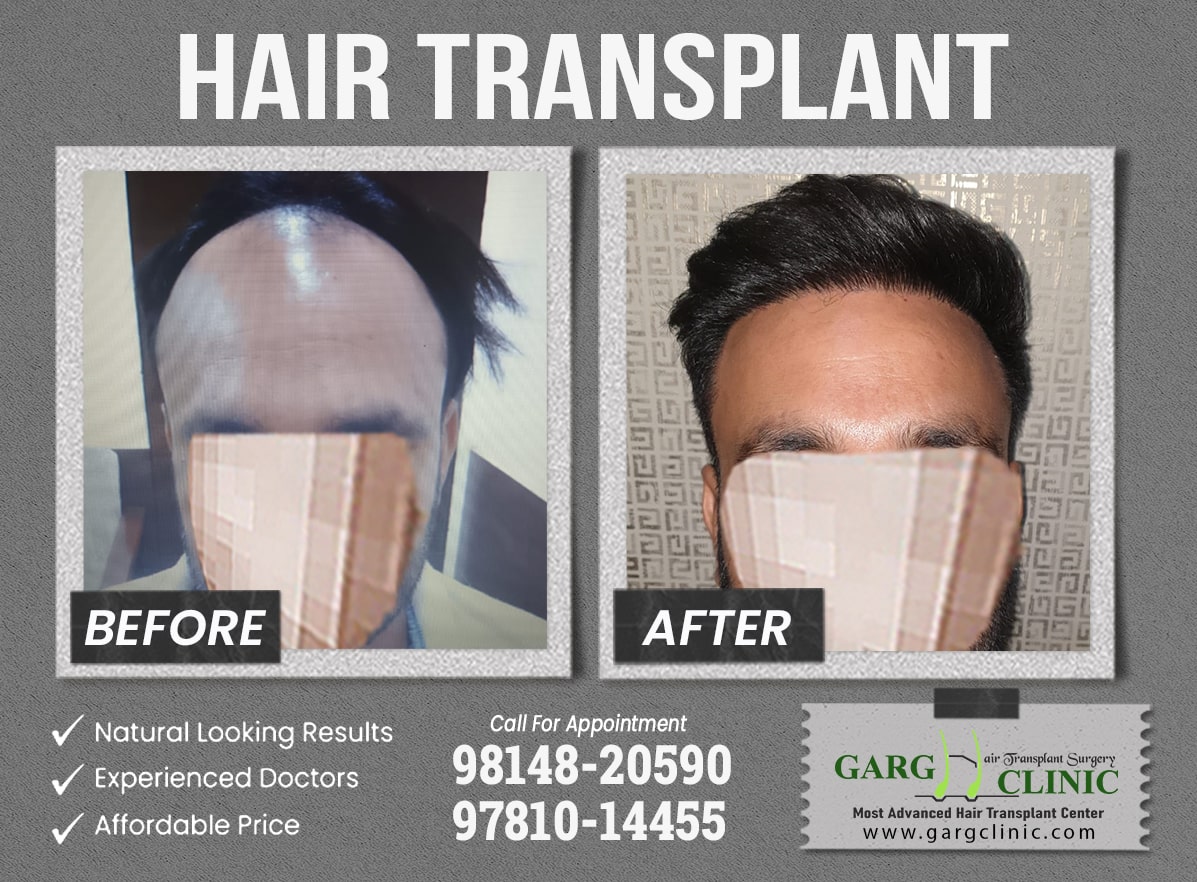 Garg Hair Transplant Clinic