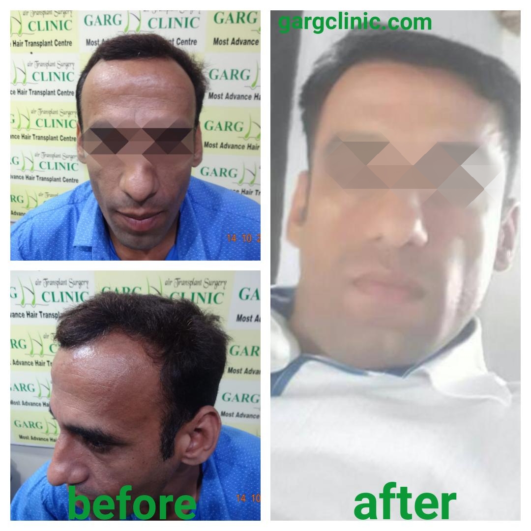 Garg Hair Transplant Clinic