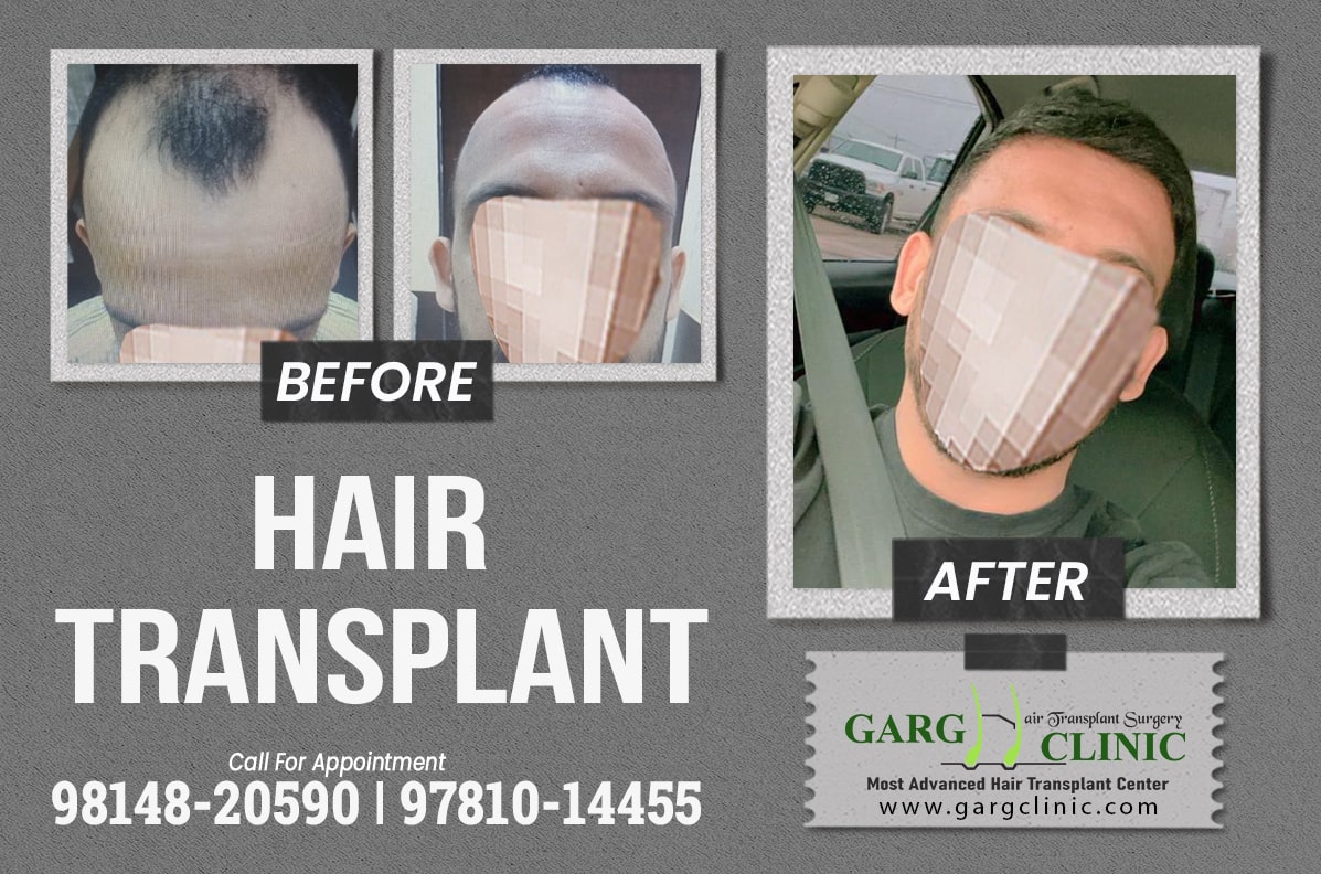Garg Hair Transplant Clinic