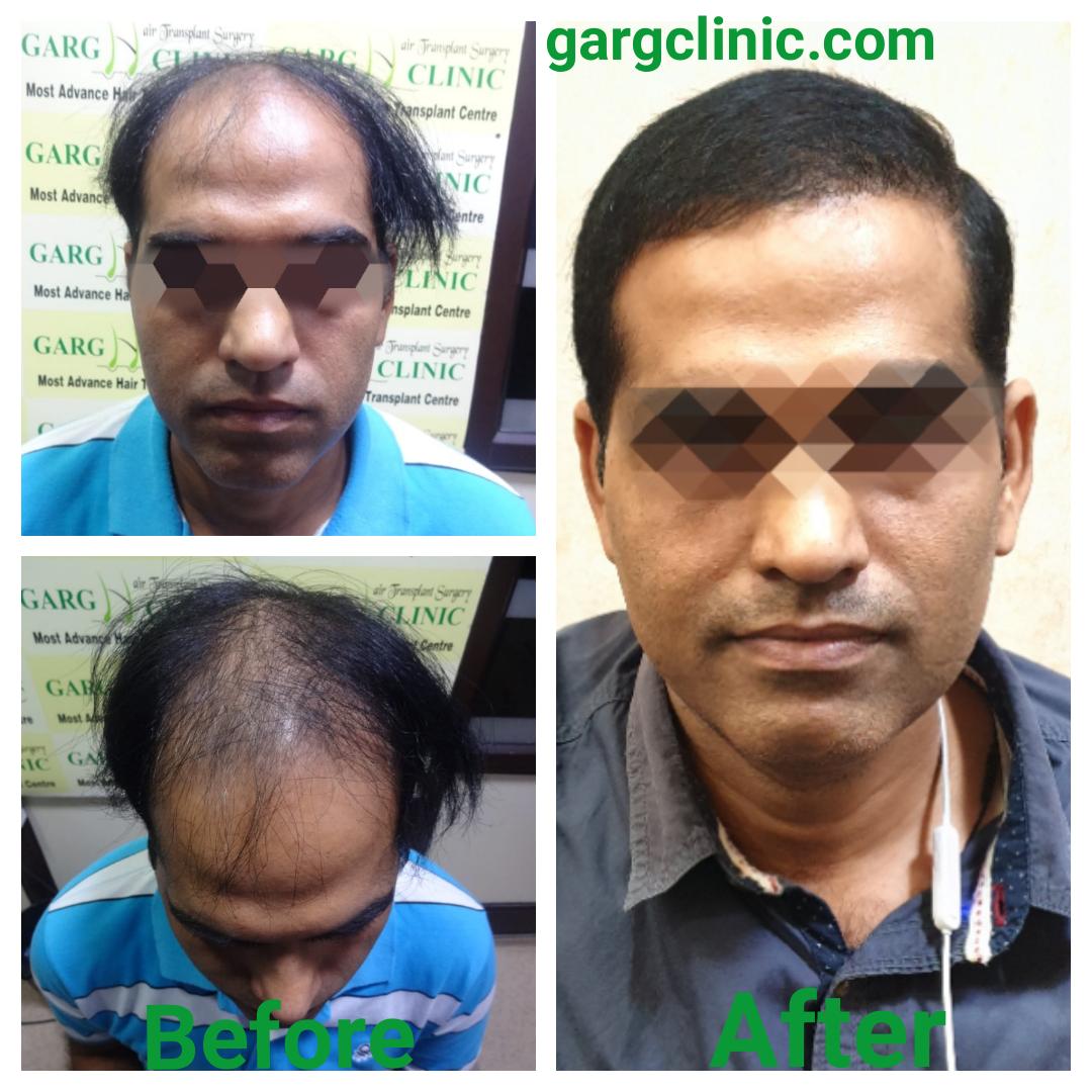 Garg Hair Transplant Clinic