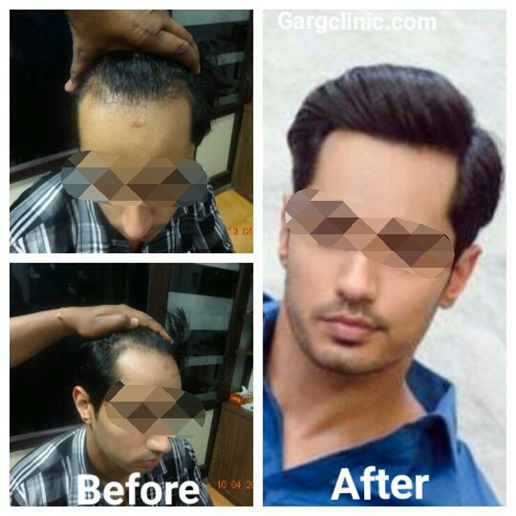 Garg Hair Transplant Clinic