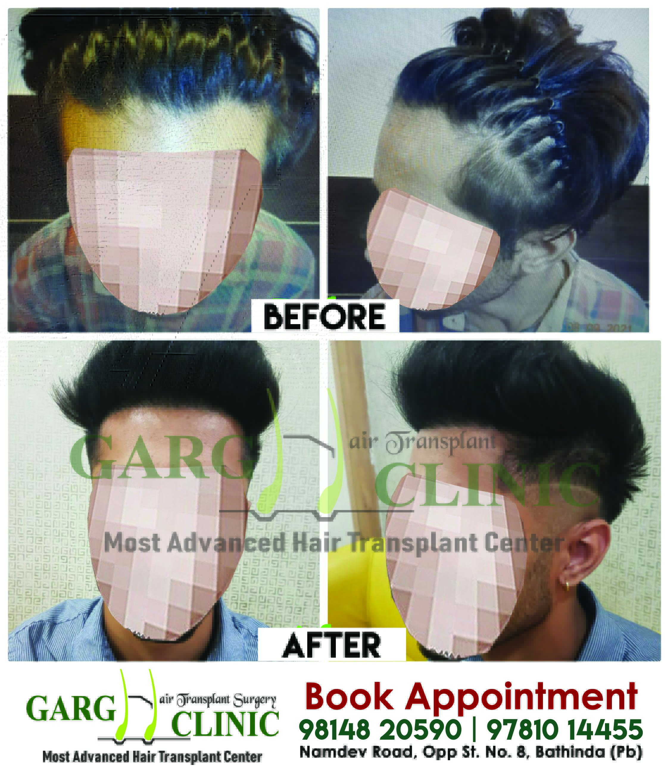 Garg Hair Transplant Clinic