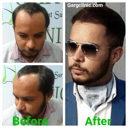 Garg Hair Transplant Clinic