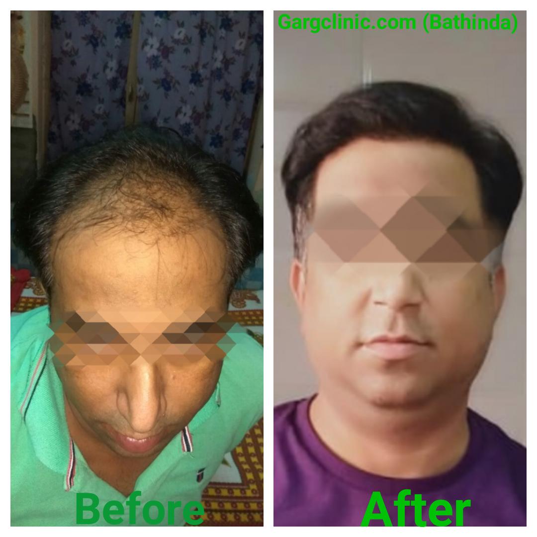 Garg Hair Transplant Clinic