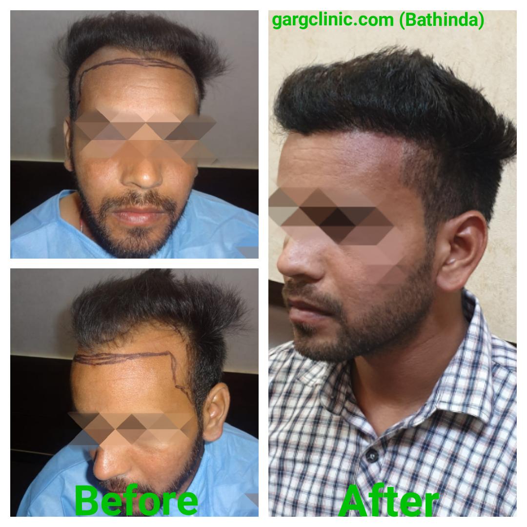Garg Hair Transplant Clinic