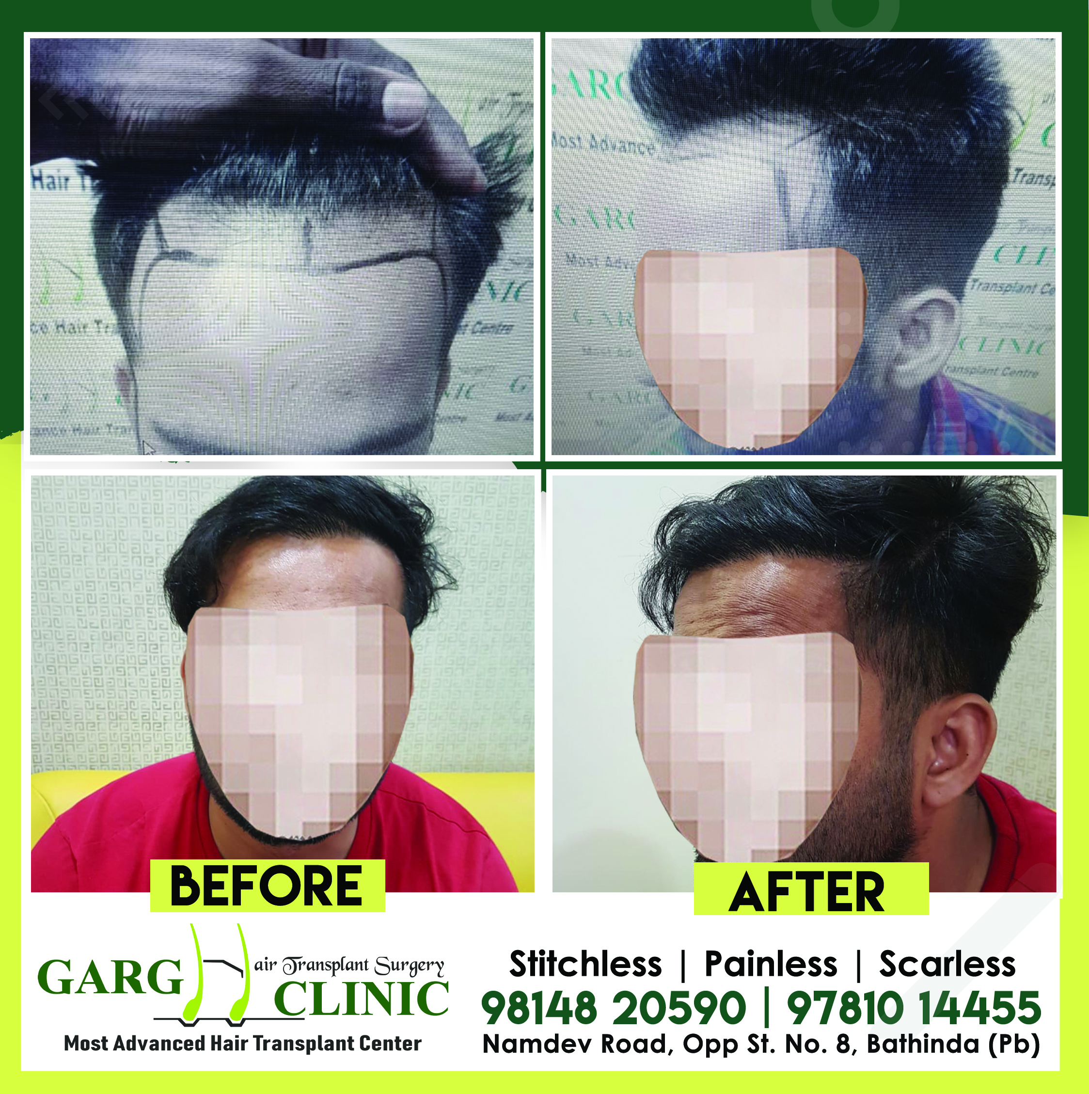 Garg Hair Transplant Clinic
