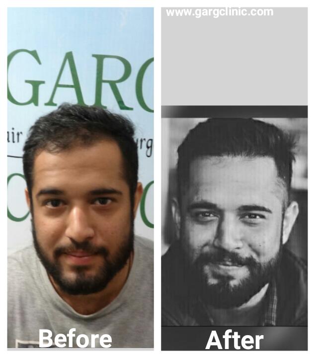 Garg Hair Transplant Clinic