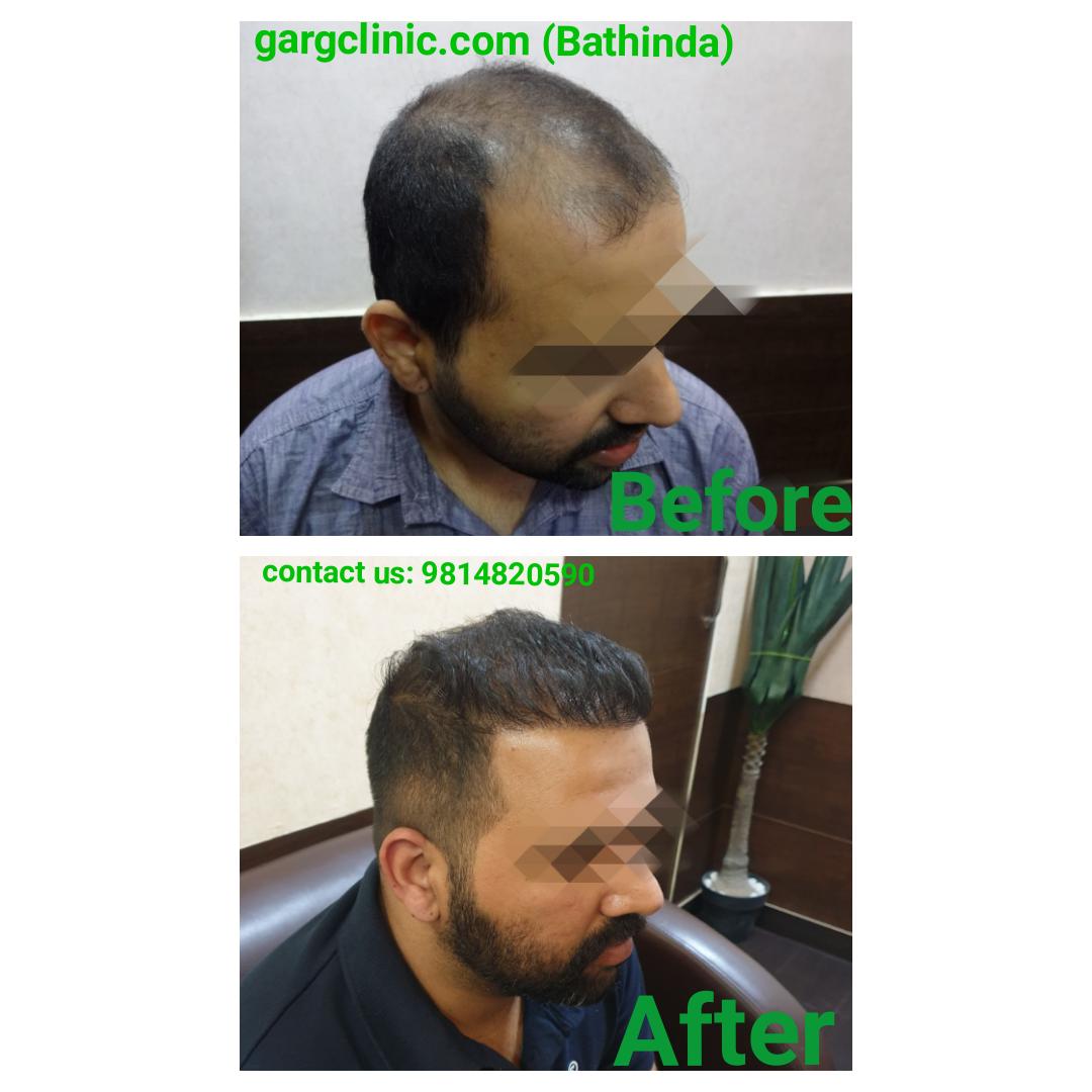 Garg Hair Transplant Clinic