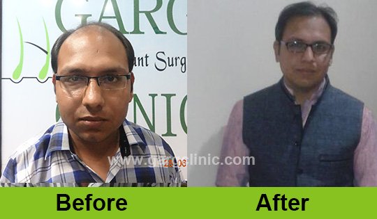 Garg Hair Transplant Clinic