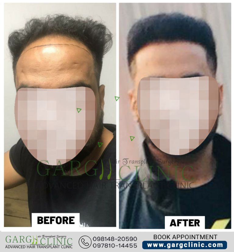 Garg Hair Transplant Clinic