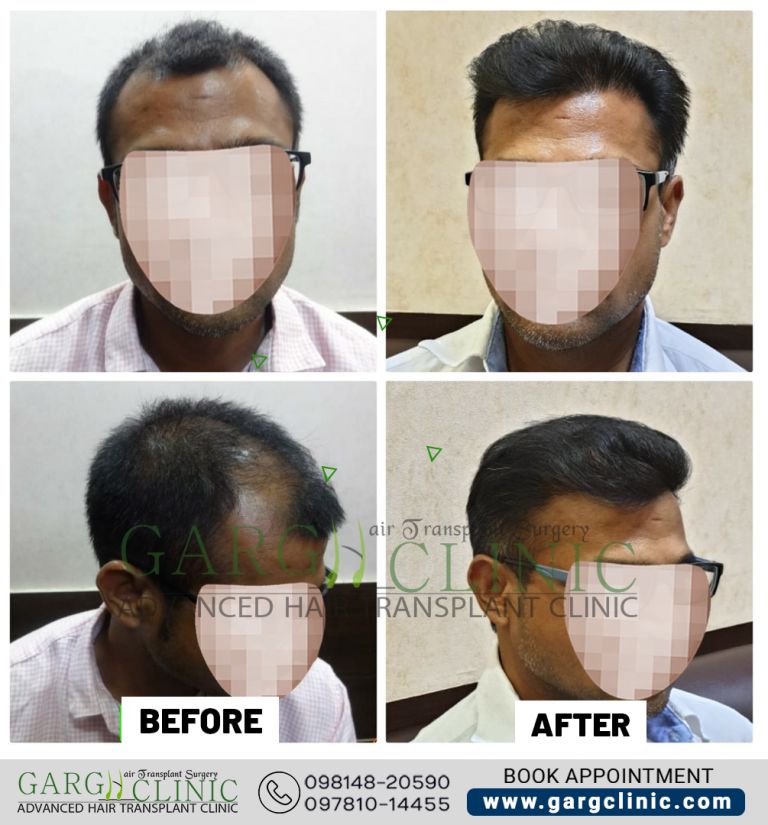 Garg Hair Transplant Clinic
