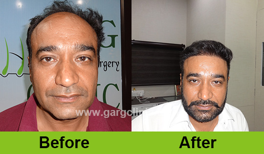 Garg Hair Transplant Clinic