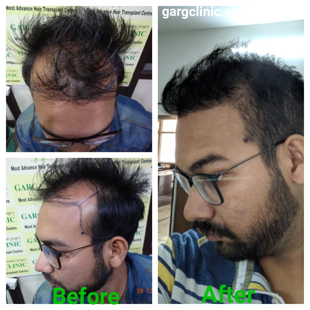 Garg Hair Transplant Clinic