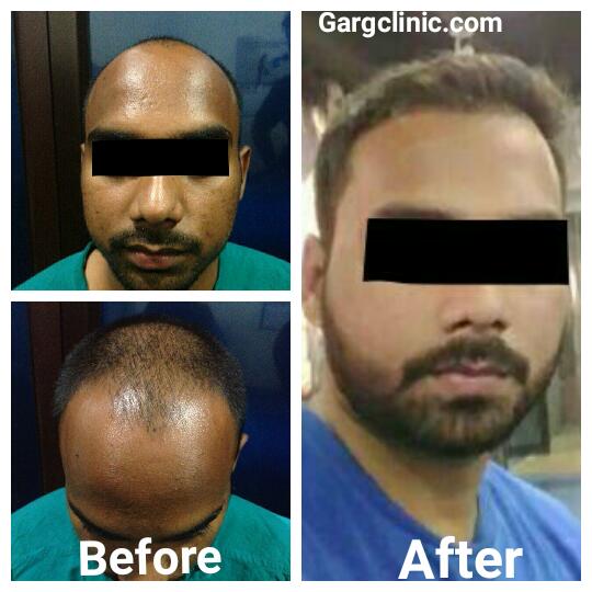 Garg Hair Transplant Clinic