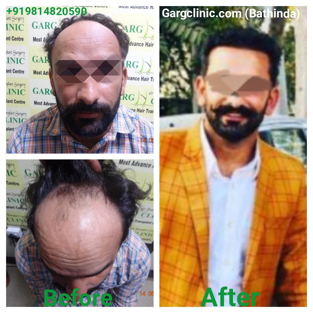 Garg Hair Transplant Clinic