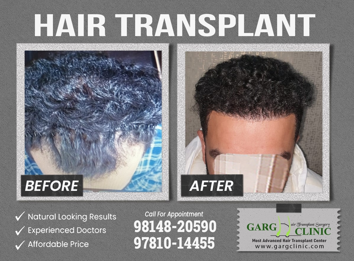 Garg Hair Transplant Clinic