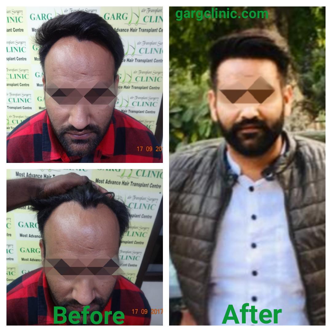 Garg Hair Transplant Clinic