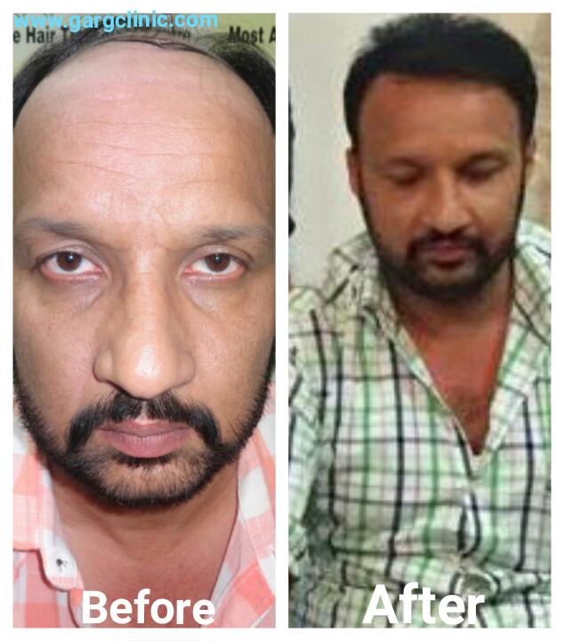 Garg Hair Transplant Clinic