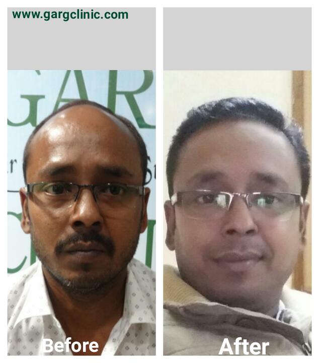 Garg Hair Transplant Clinic