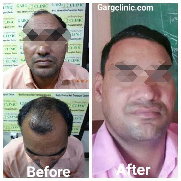 Garg Hair Transplant Clinic