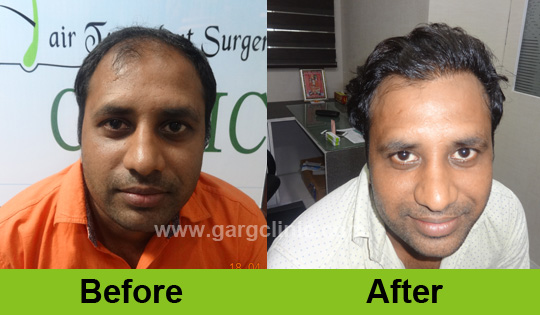 Garg Hair Transplant Clinic