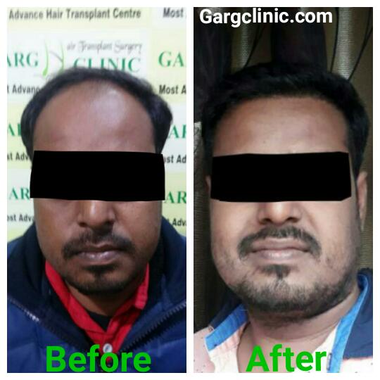 Garg Hair Transplant Clinic