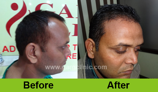 Garg Hair Transplant Clinic