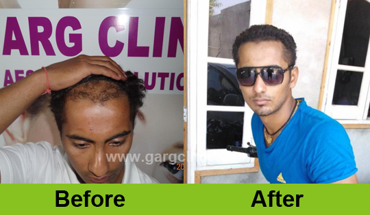 Garg Hair Transplant Clinic