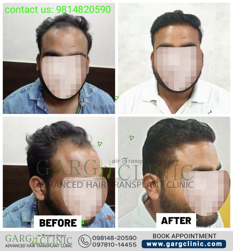 Garg Hair Transplant Clinic