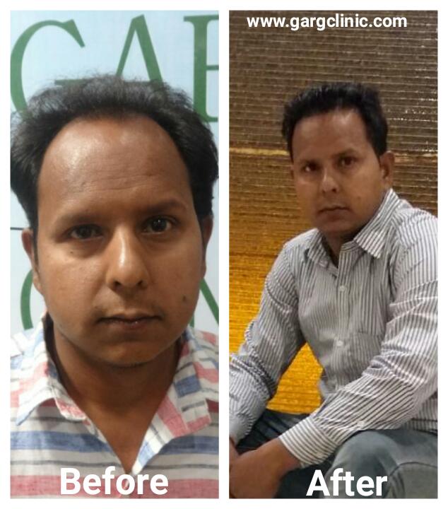 Garg Hair Transplant Clinic