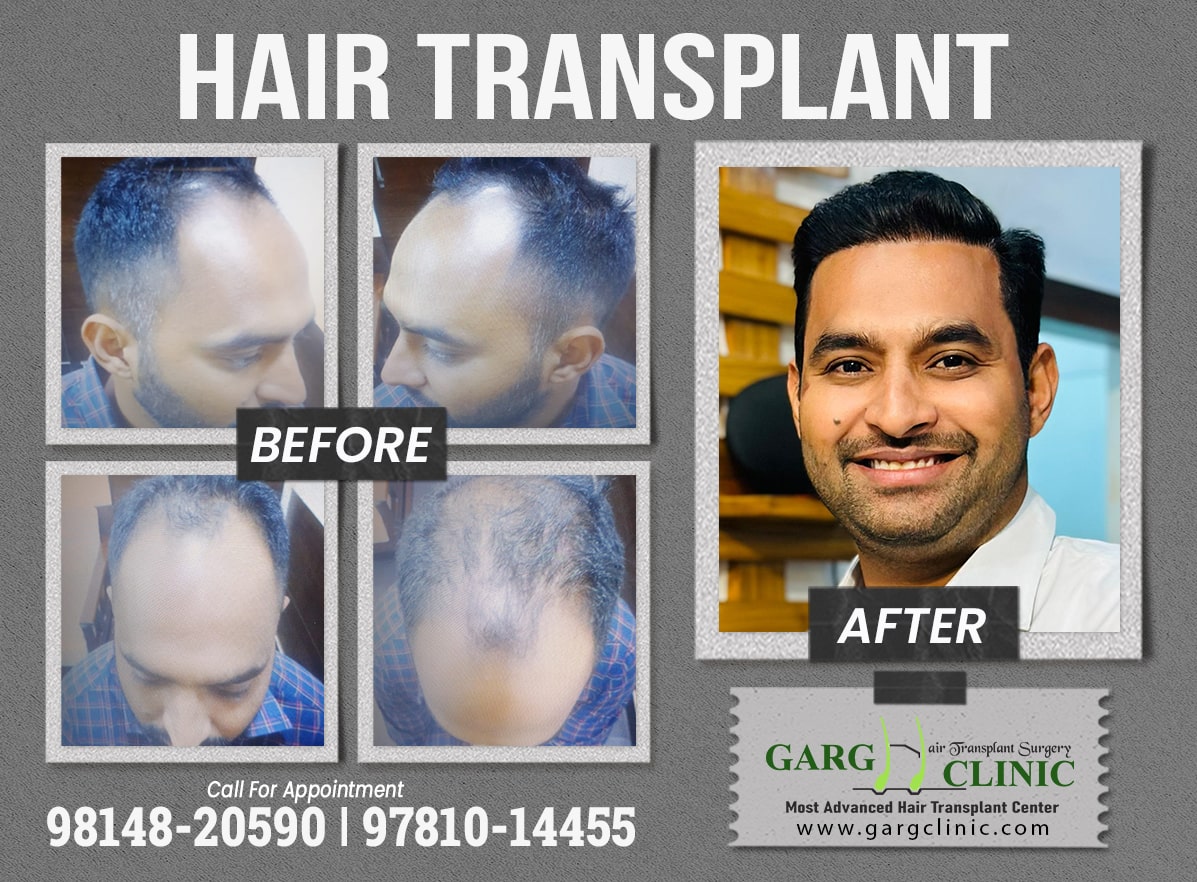 Garg Hair Transplant Clinic