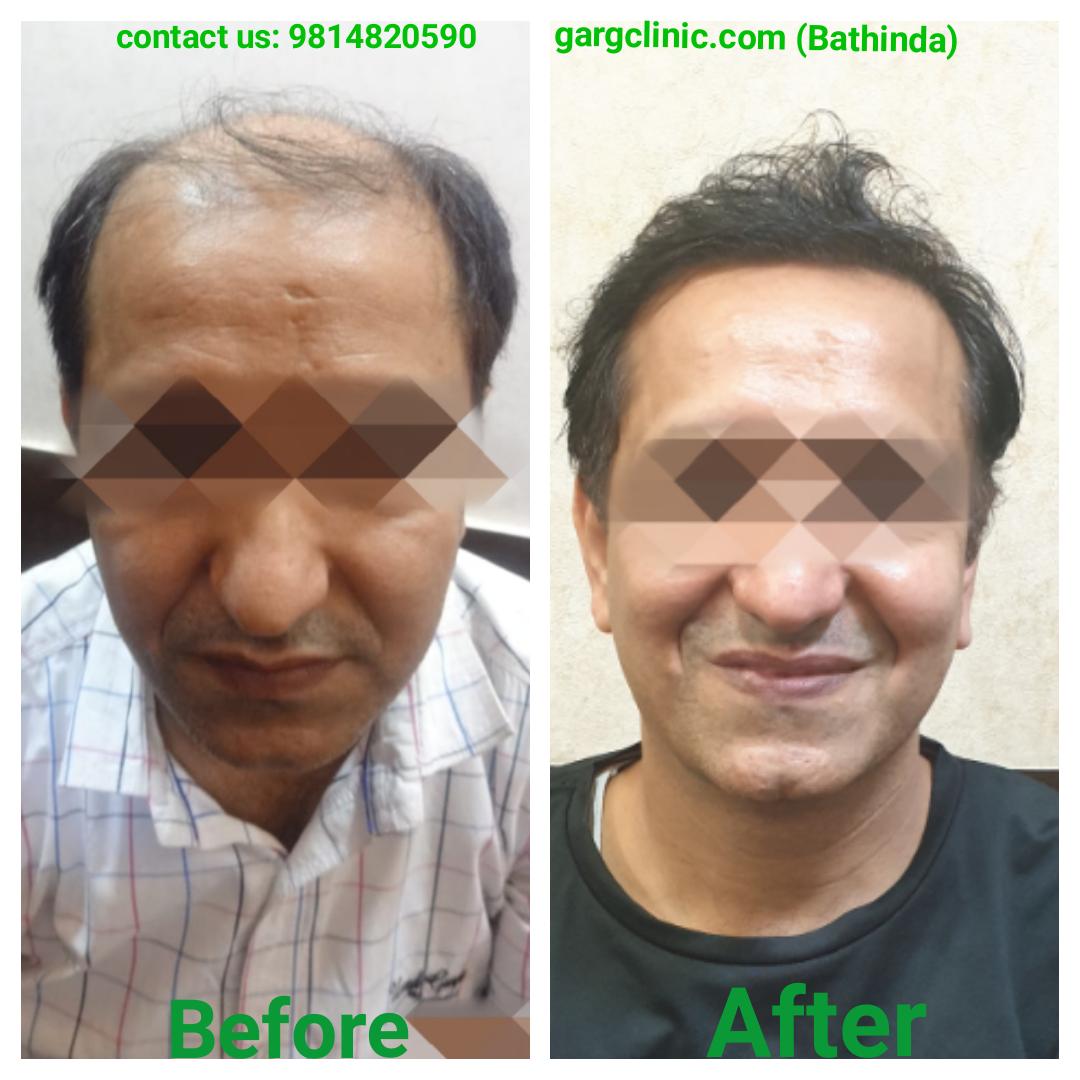 Garg Hair Transplant Clinic