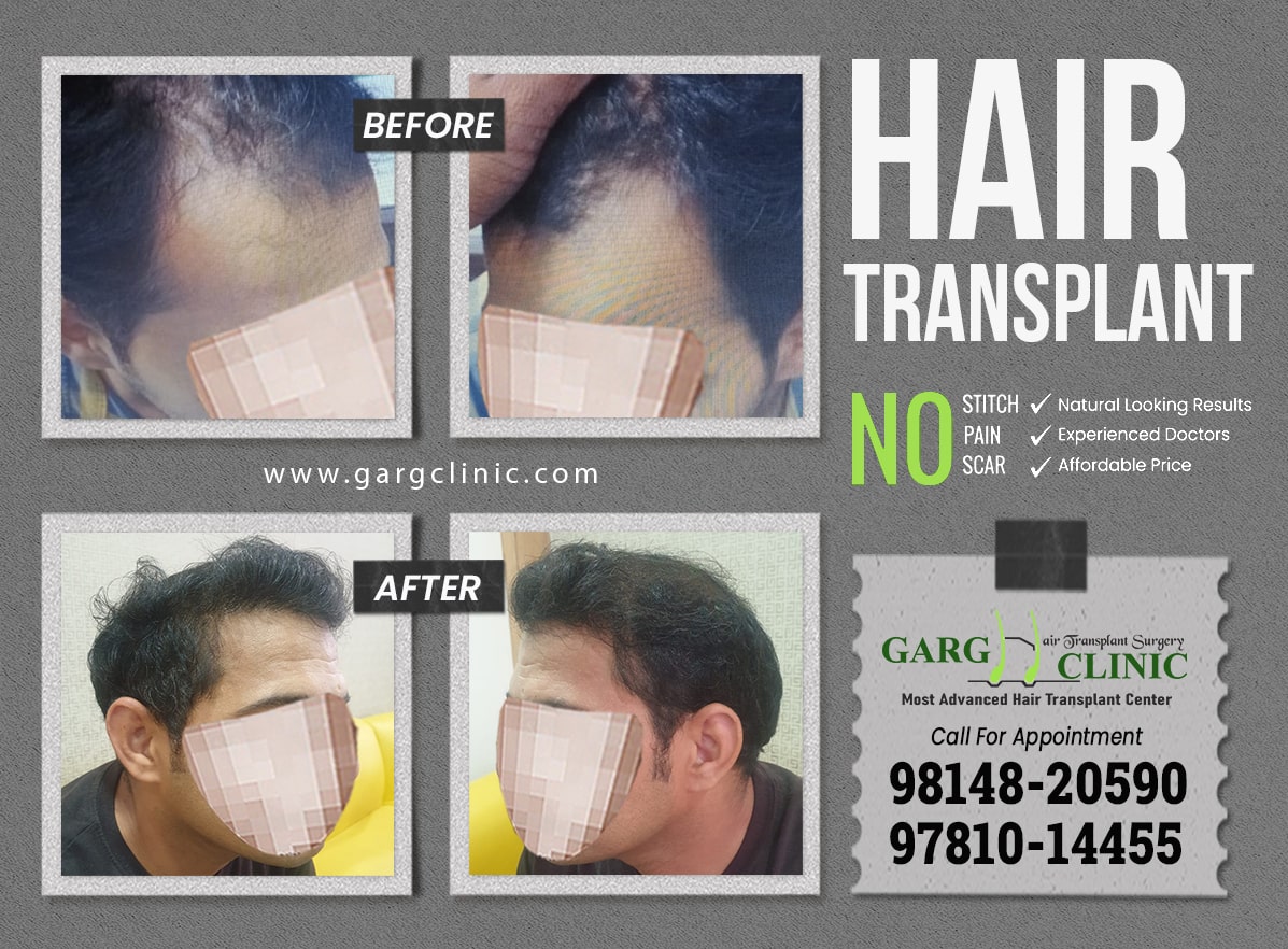 Garg Hair Transplant Clinic