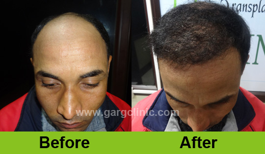 Garg Hair Transplant Clinic
