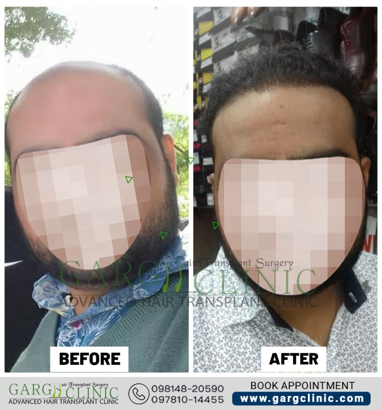 Garg Hair Transplant Clinic