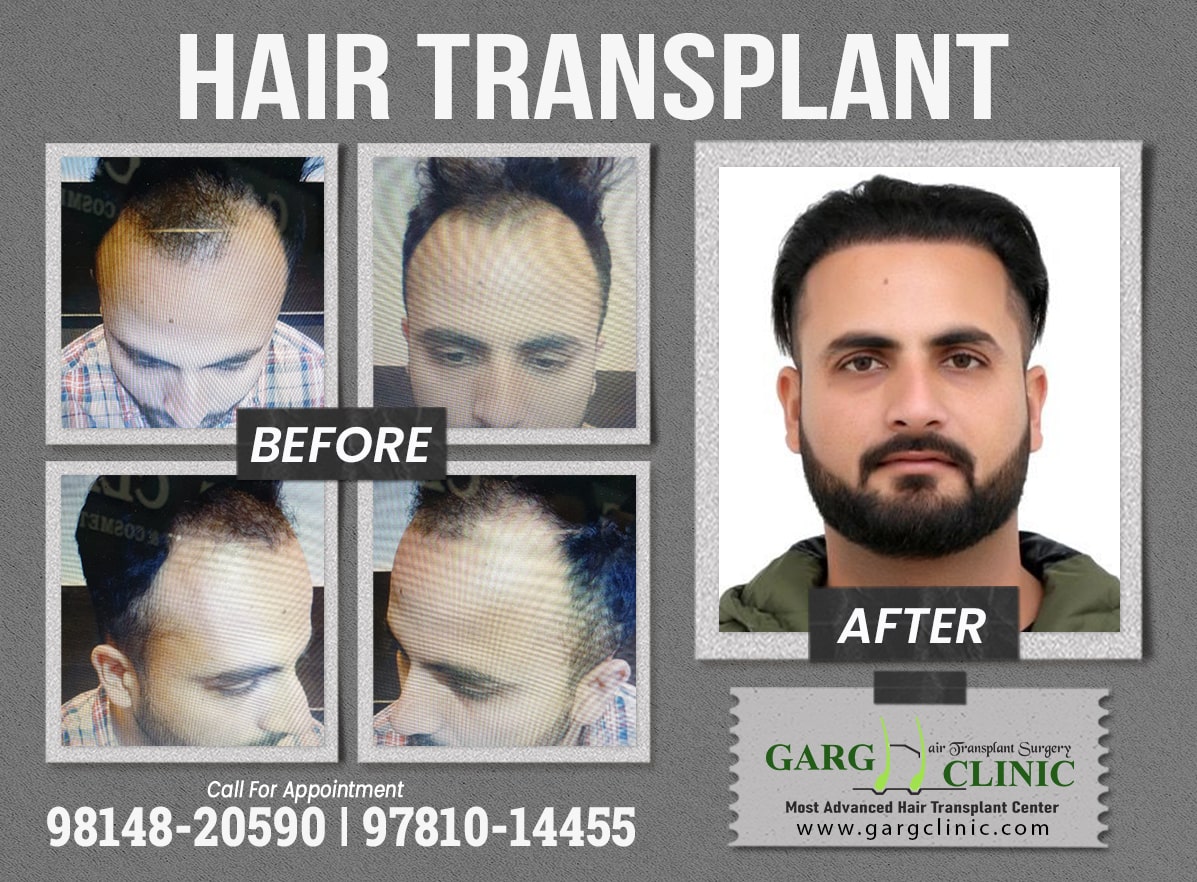 Garg Hair Transplant Clinic