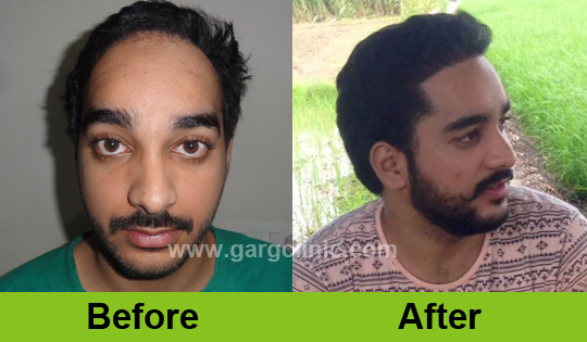 Garg Hair Transplant Clinic