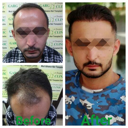 Garg Hair Transplant Clinic