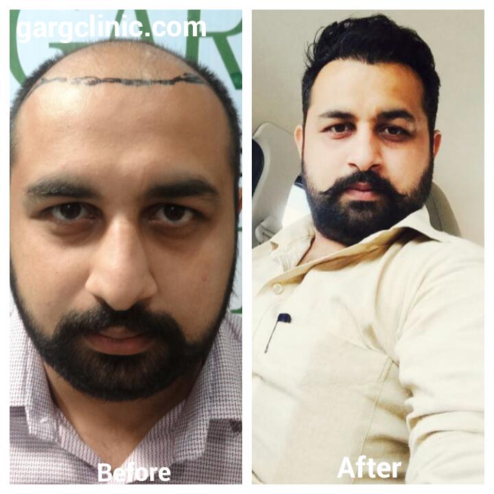 Garg Hair Transplant Clinic